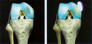Knorpelrekonstruktion durch ACT (autologe Chondrocytentransplantation)